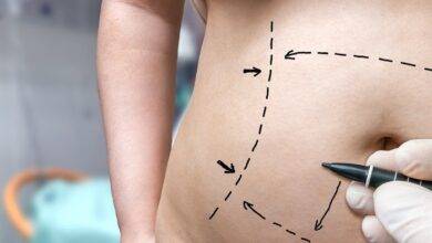 7 Incredible Benefits of Liposuction
